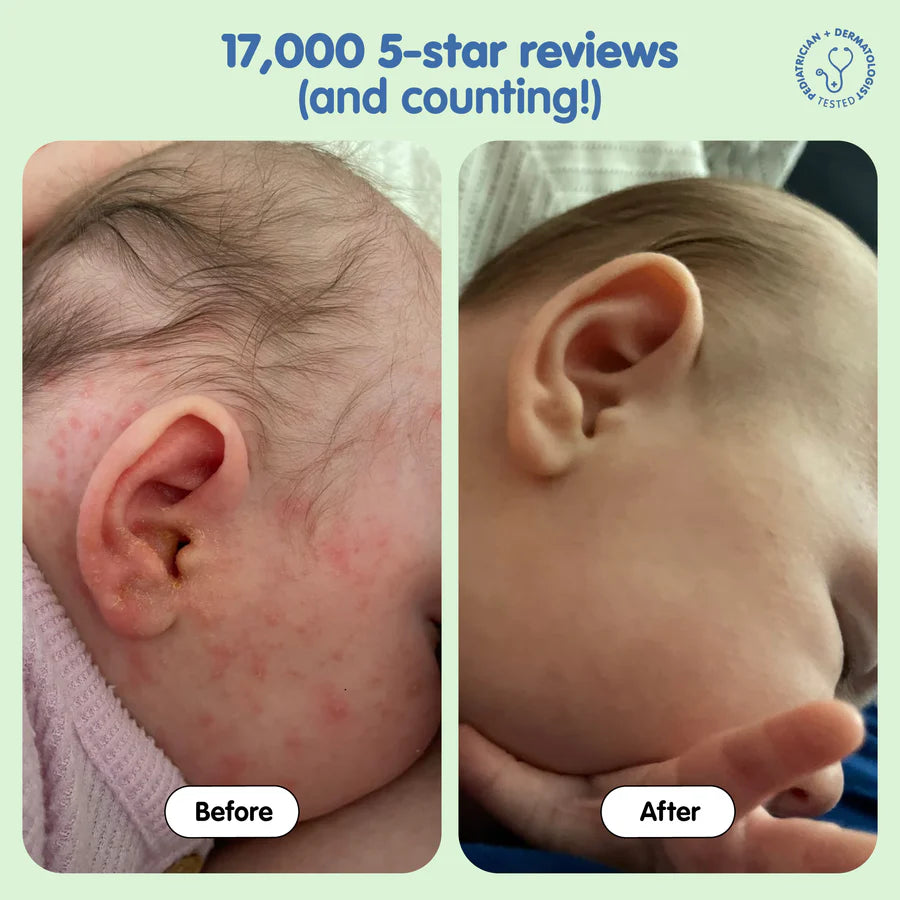 All Over Ointment Eczema Treatment